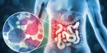 colorectal cancer
