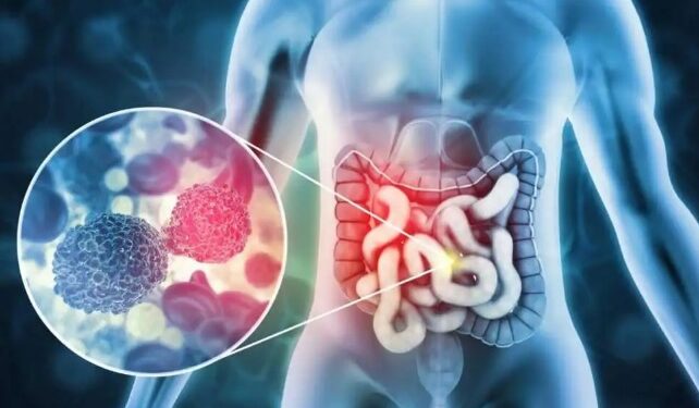 colorectal cancer