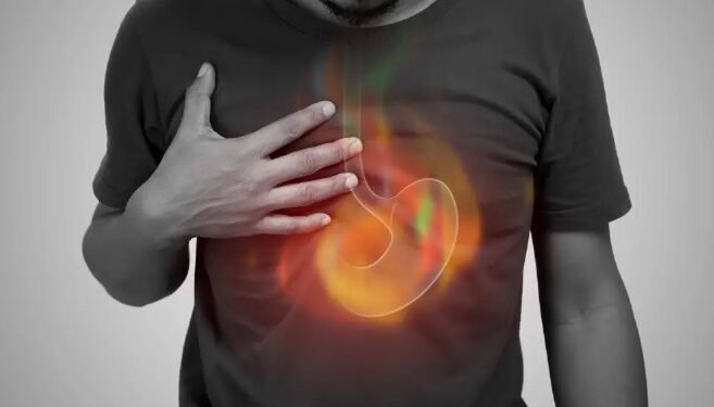 acid reflux