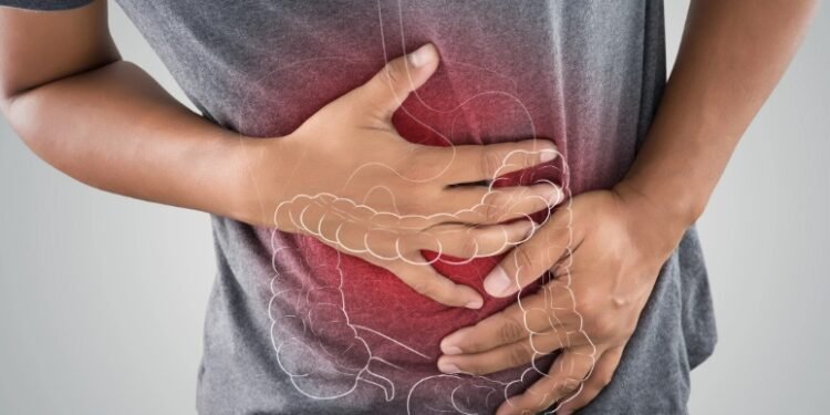 Colon Cancer