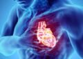 cardiac arrest