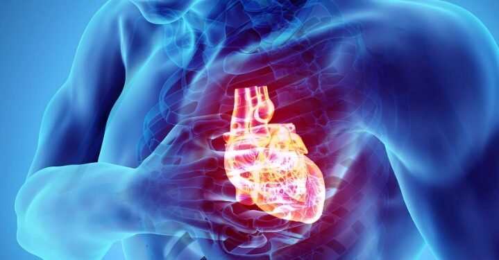 cardiac arrest
